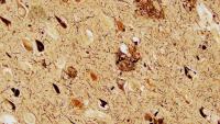 Microscopic view of amyloid plaques